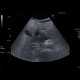 Acute pancreatitis on ultrasound: US - Ultrasound